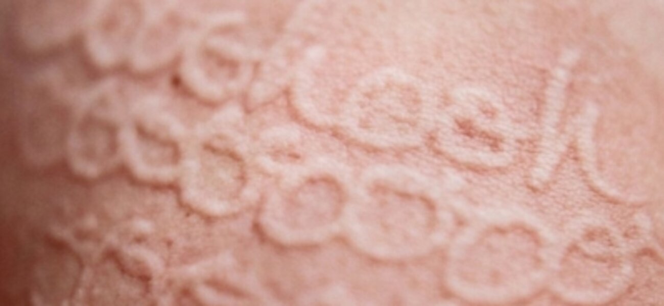 Photographer Turns Skin Condition Into Art