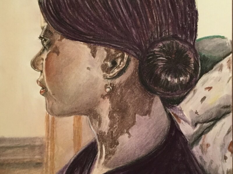 Vitiligo 