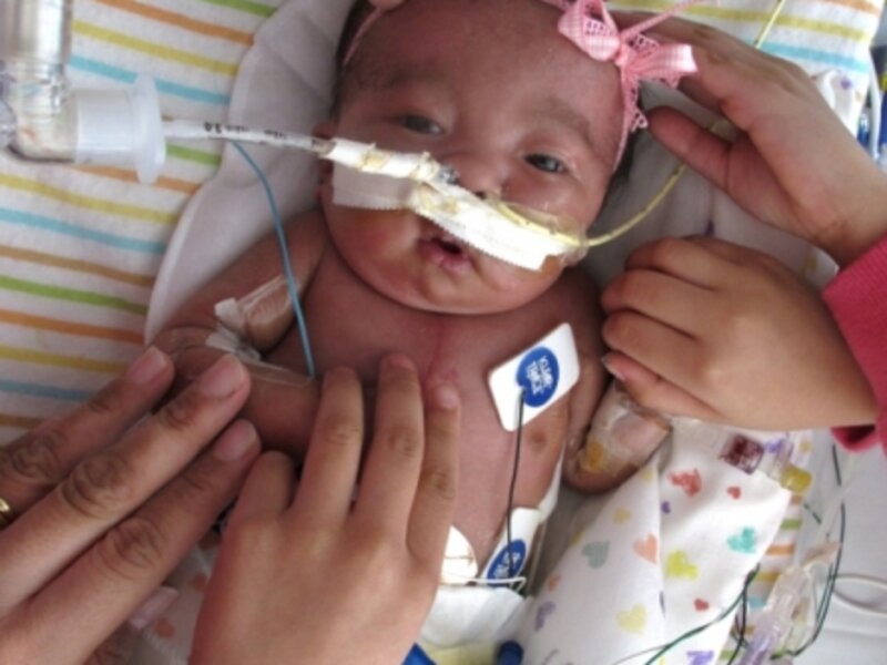 Gabriella Joy Estrada Trisomy 18